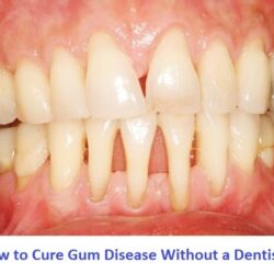 How to cure gum disease without a dentist